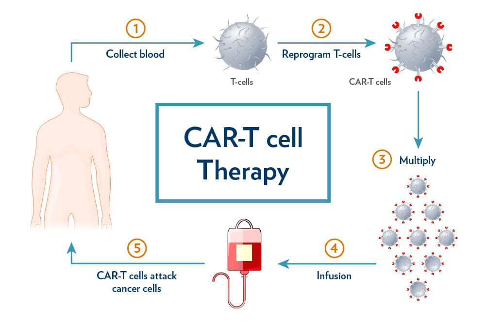 diagram showing the five steps of the CAR-T cell therapy process: collect blood, reprogram T-cells, multiply, infusion, CAR-T cells attack cancer cells