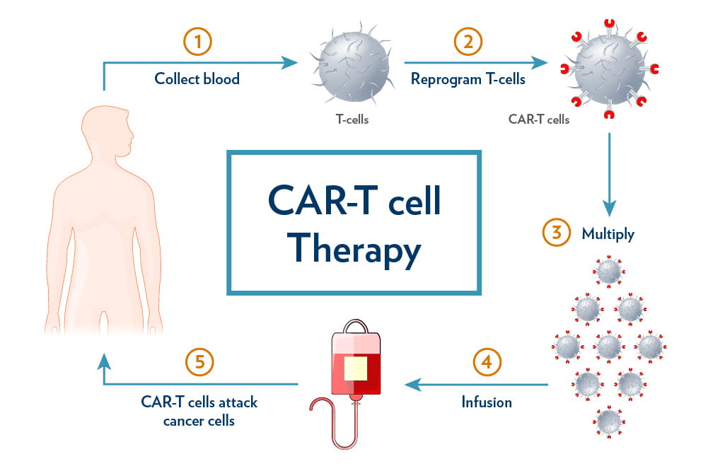 CAR T Cell Therapy MUSC Hollings Cancer Center CAR T Cell Therapy MUSC Hollings Cancer Center