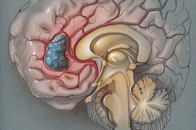 illustration of a brain with a tumor in the front part