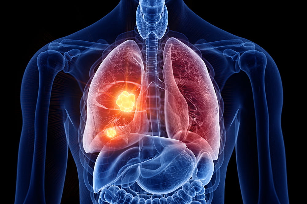 3D rendering of the chest cavity with the lungs highlighted and a tumor showing in one lung