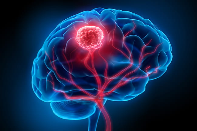 a 3D illustration of a brain with a tumor highlighted in red