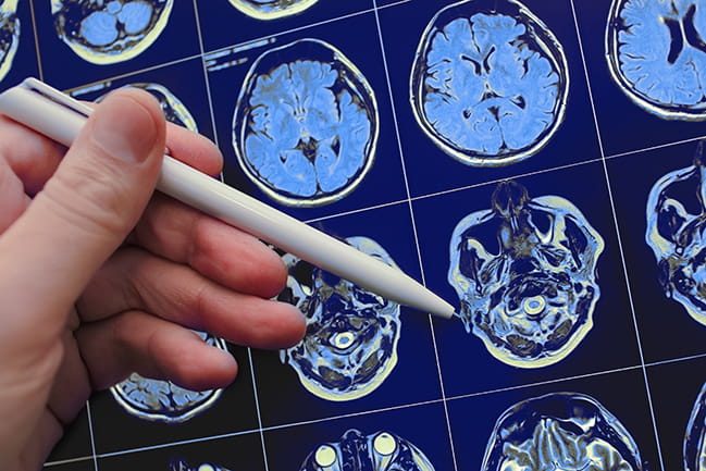 a hand holding a pen points to one image among a grid of brain scan images