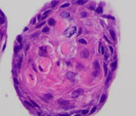 close up image of oral squamous cell carcinoma organoids