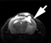 MRI scan with arrow indicating tumor location
