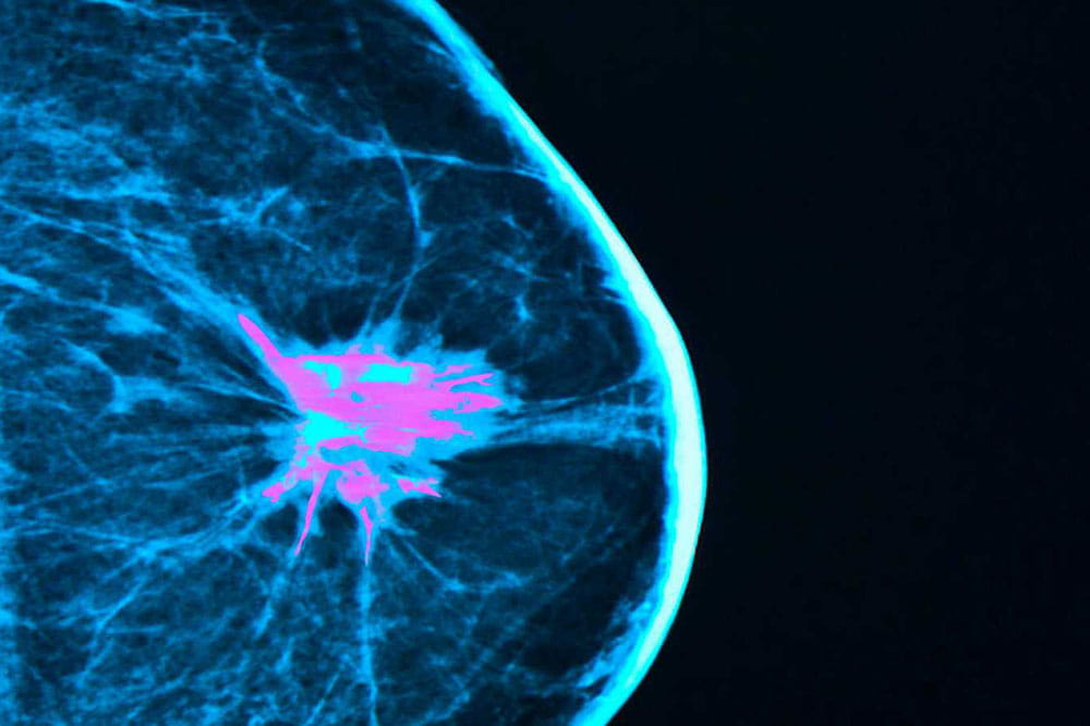mammogram image