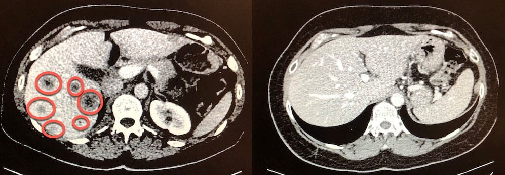 before and after breast cancer scan images for Jennifer Attisano