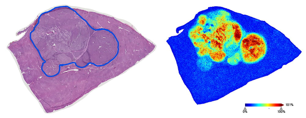 histological stain of an HCC tumor tissue with the tumor region outlined in blue on the left and expression of an N-glycan structure from MALDI-IMS on the right