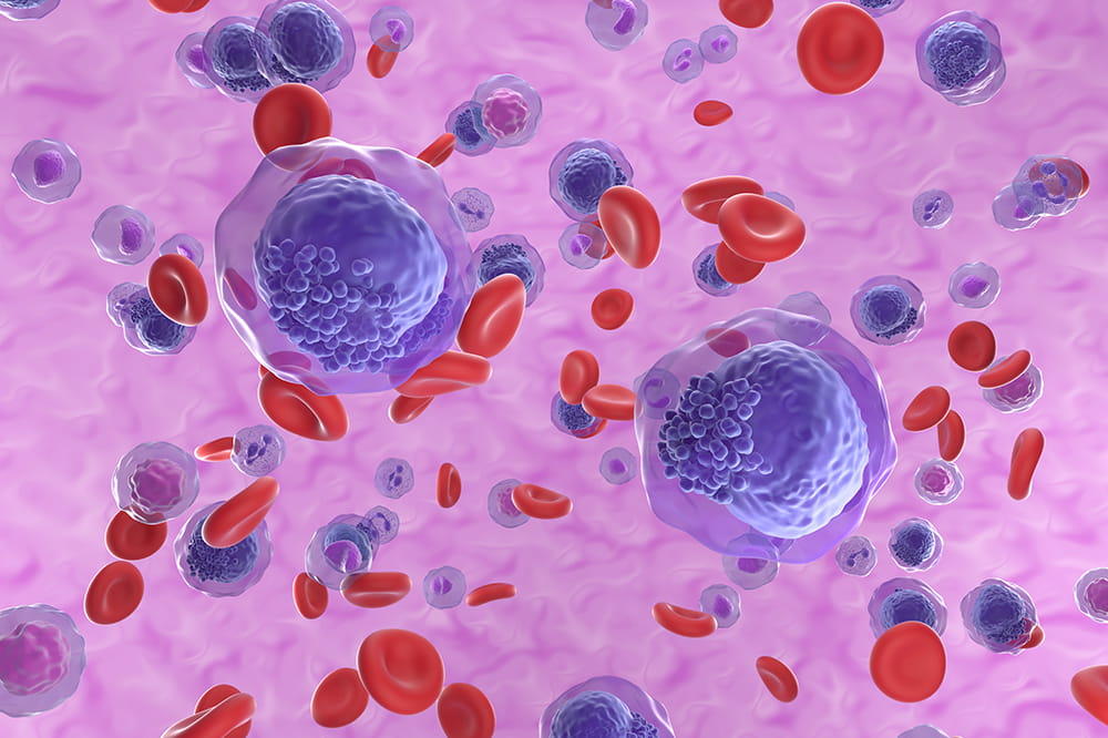 illustration of acute myeloid leukemia cells in the bloodstream