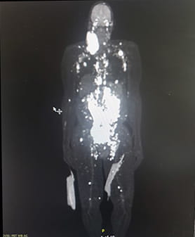 a full body scan showing cancer in the body