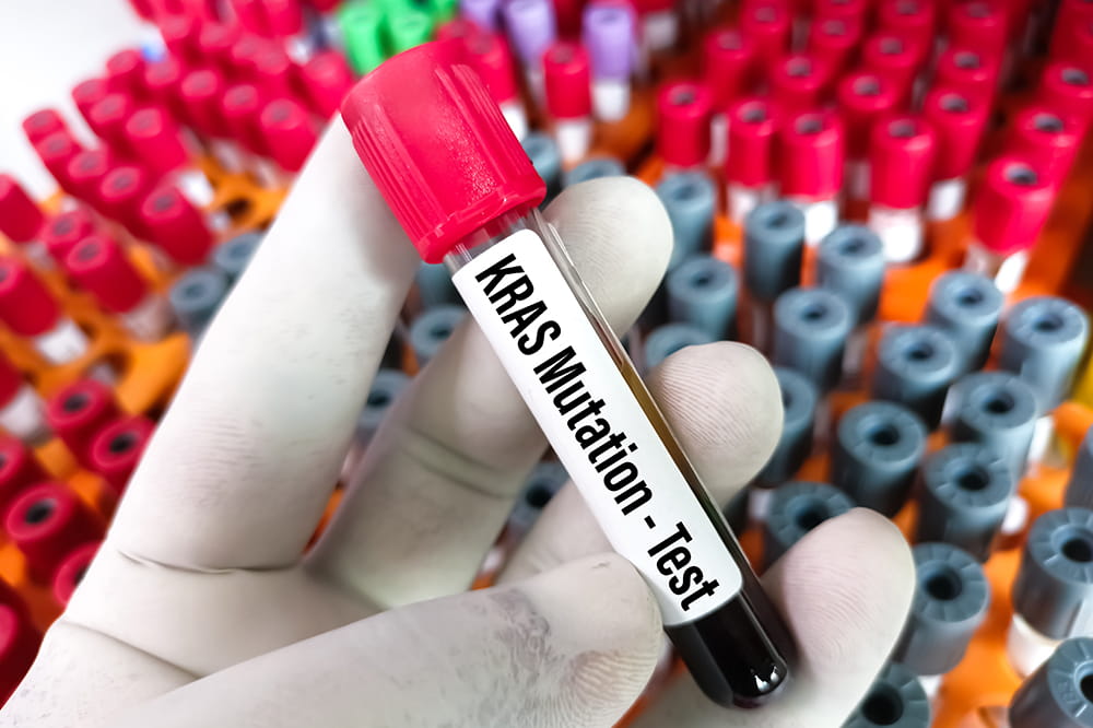 a glove hand holds a blood vial labeled KRAS mutation test
